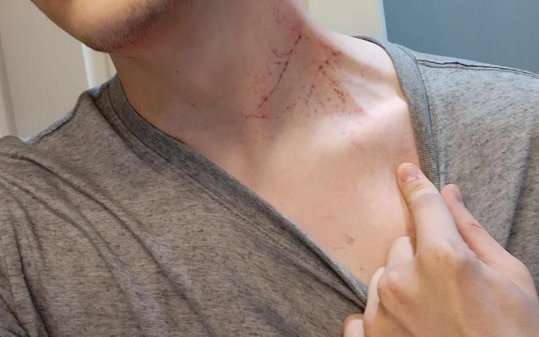 Image of a person with scratches on their neck